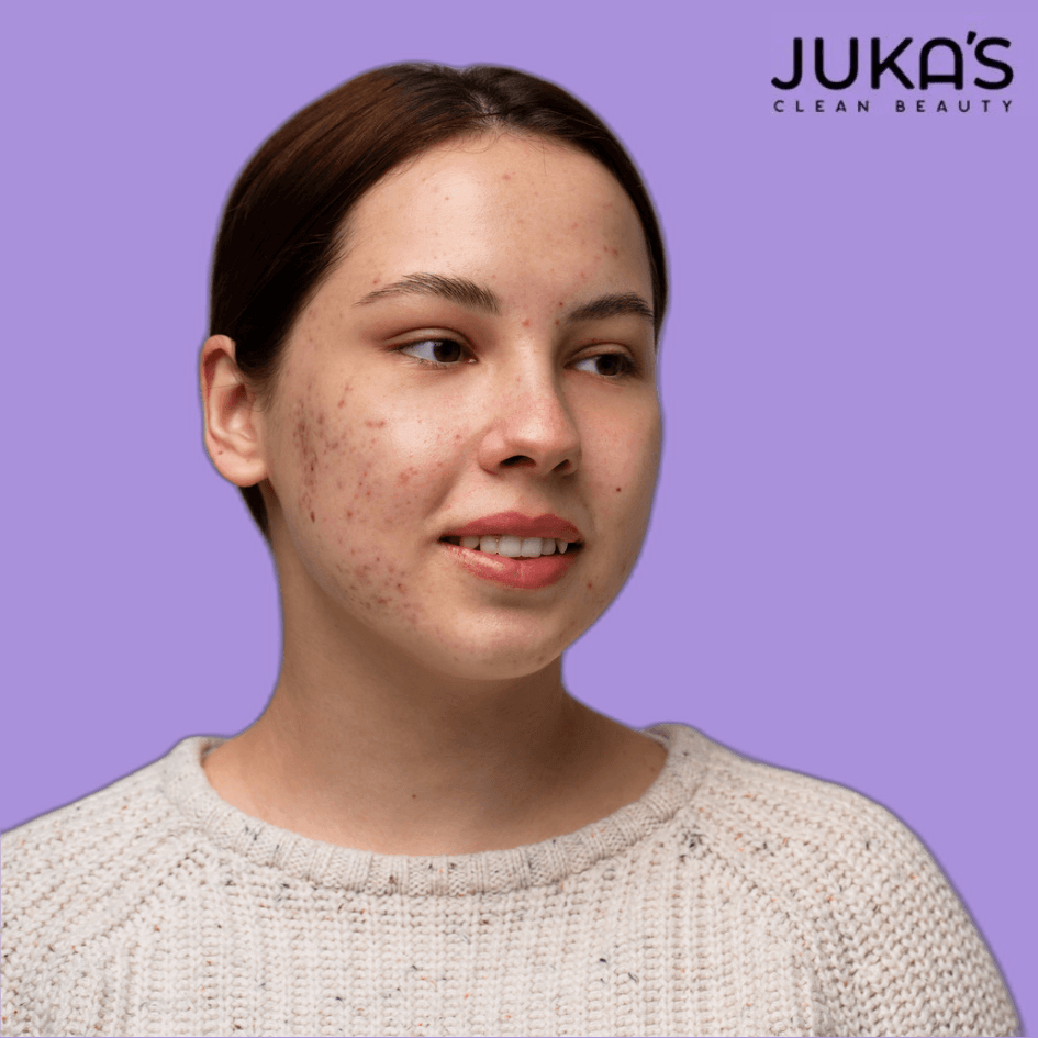 Buy Juka's Hyperpigmentation Moisturizer to remove dark spot on your face 
