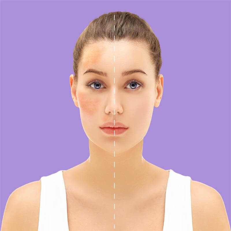 Kojic acid hyper glow kit reducing dark spots on face