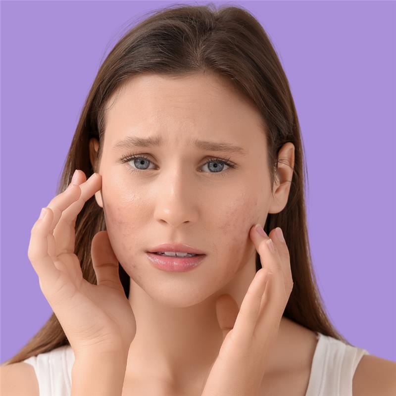 Acnes gentle cleanser in Juka’s acne skincare kit