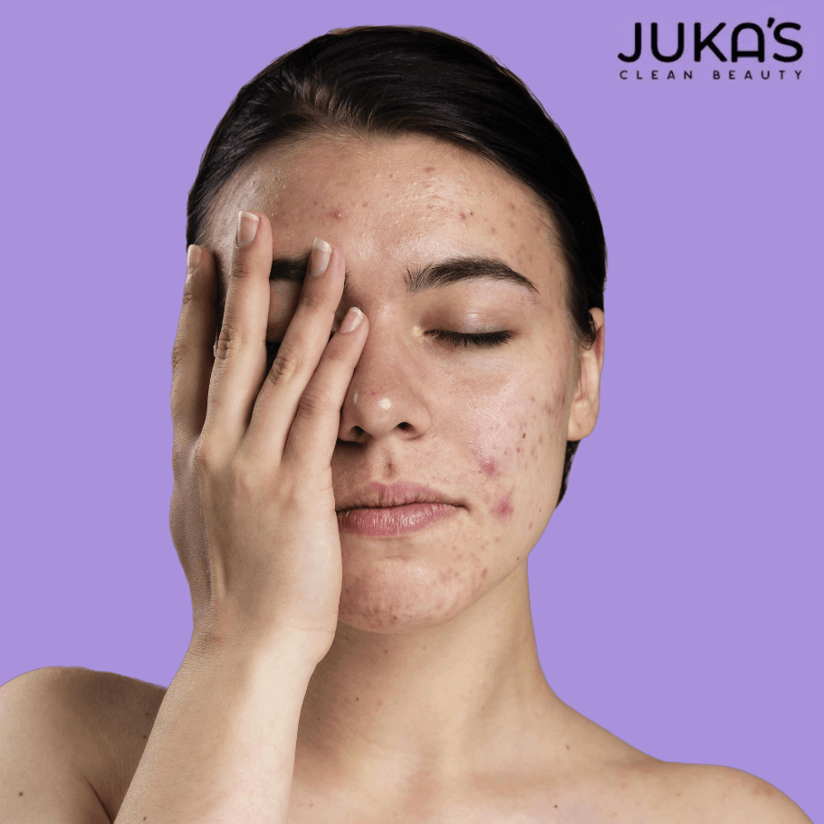 Buy Best moisturizer for Hyperpigmentation for your Skin