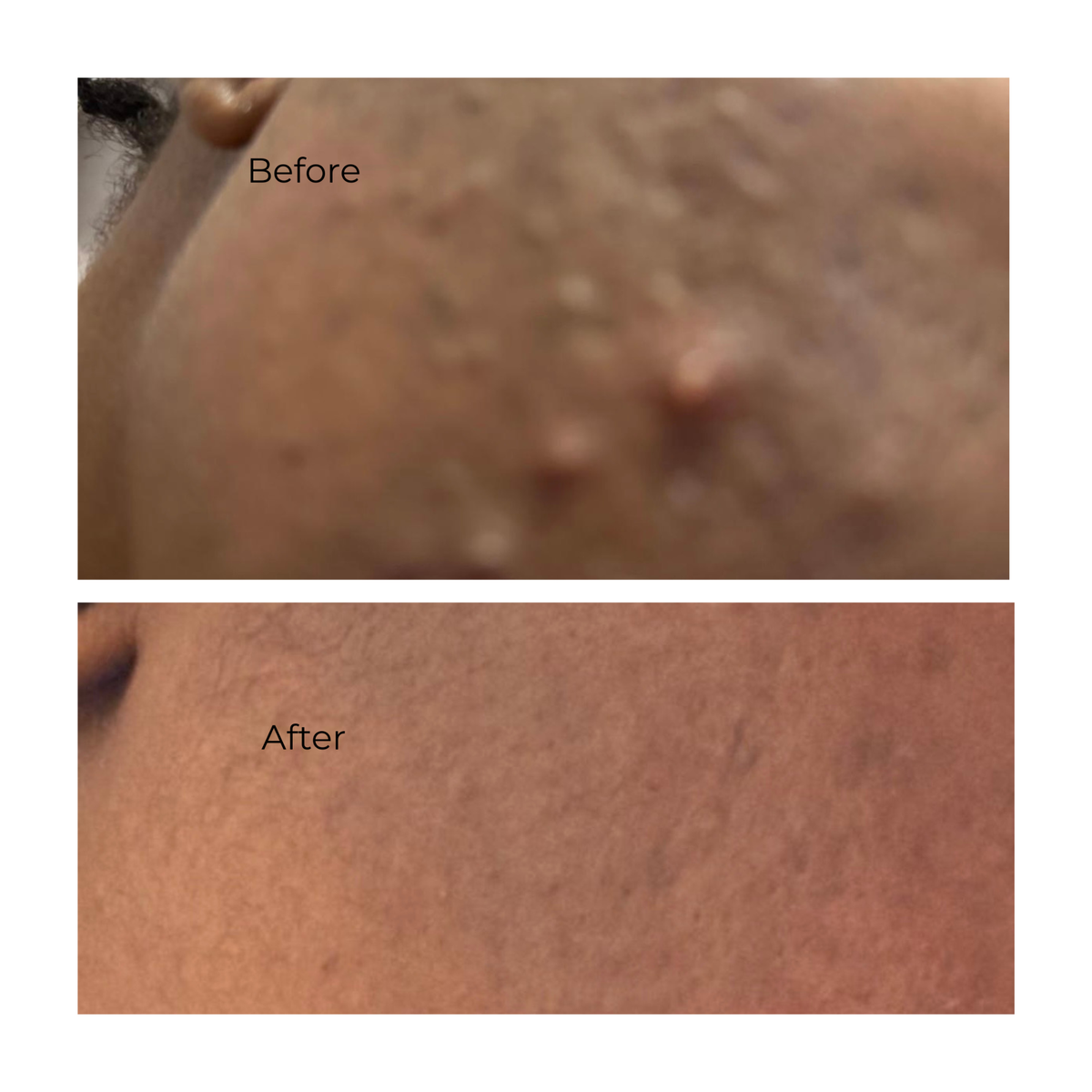 Acne Free Kit - For Acne Prone Skin